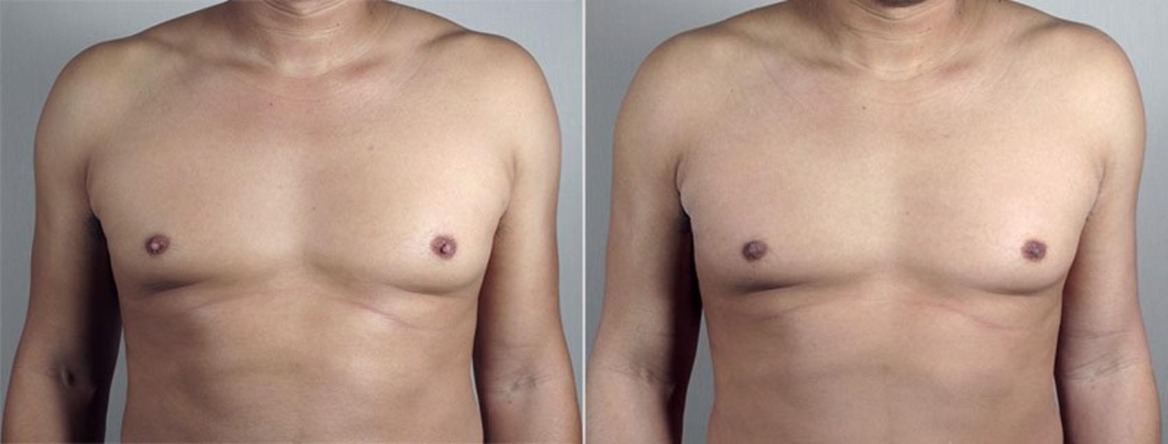 Nipple Procedures Case 572 Before & After View #1 | Paramus, New Jersey | Parker Center for Plastic Surgery