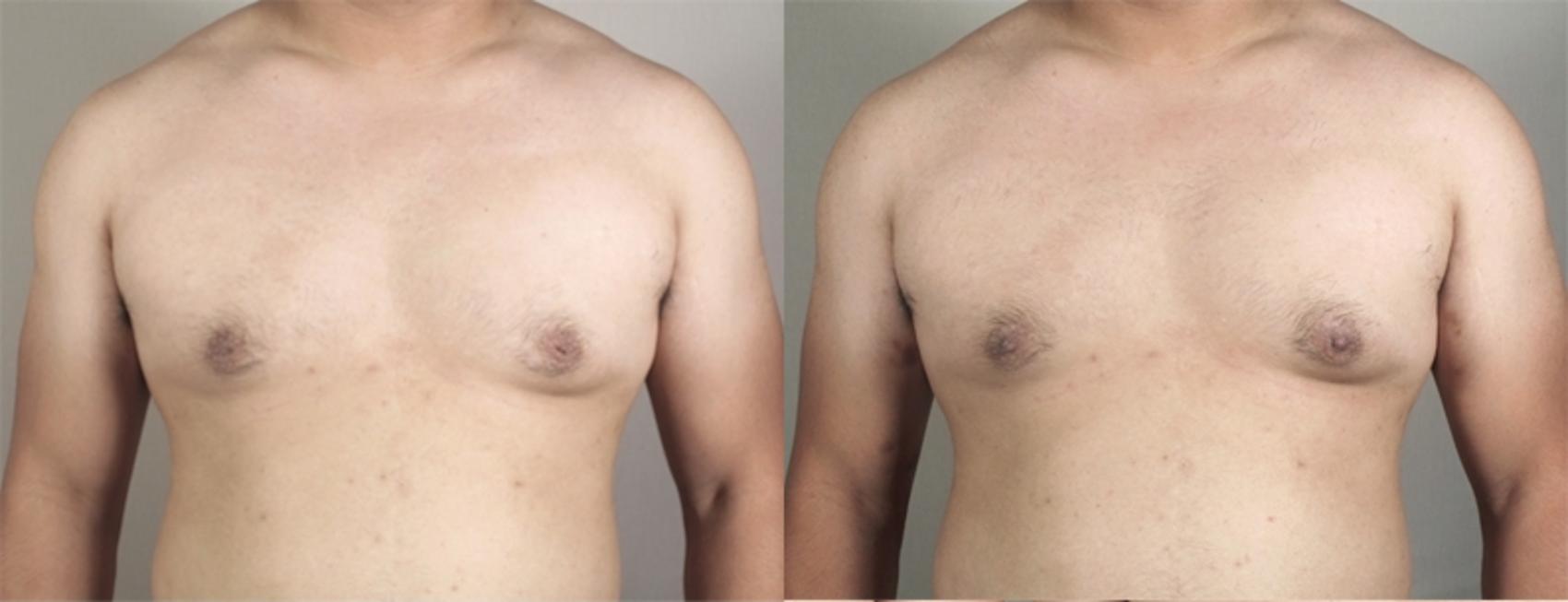 Nipple Procedures Case 941 Before & After View #5 | Paramus, New Jersey | Parker Center for Plastic Surgery