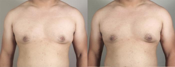Nipple Procedures Case 941 Before & After View #5 | Paramus, New Jersey | Parker Center for Plastic Surgery