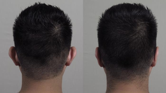 Otoplasty Case 1018 Before & After Back | Paramus, New Jersey | Parker Center for Plastic Surgery