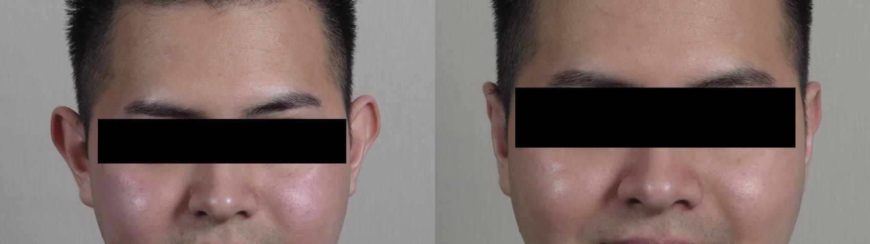Otoplasty Case 1018 Before & After Front | Paramus, New Jersey | Parker Center for Plastic Surgery