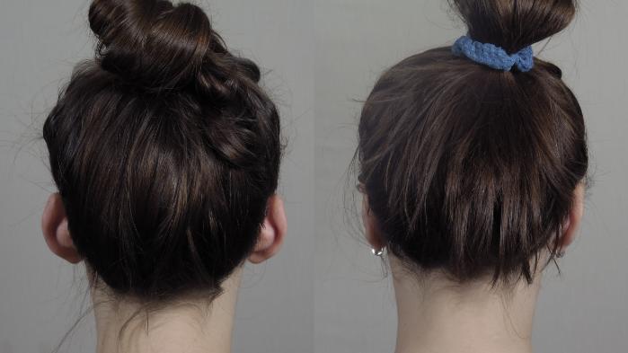 Otoplasty Case 1019 Before & After Back | Paramus, New Jersey | Parker Center for Plastic Surgery