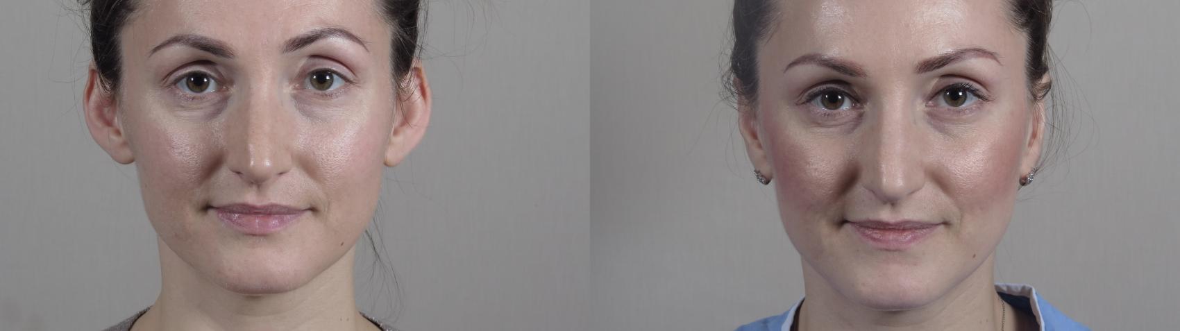 Otoplasty Case 1019 Before & After Front | Paramus, New Jersey | Parker Center for Plastic Surgery
