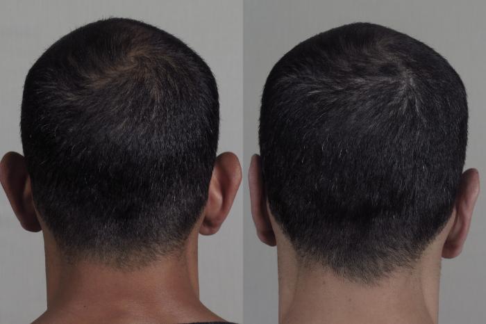 Otoplasty Case 1096 Before & After Back | Paramus, New Jersey | Parker Center for Plastic Surgery