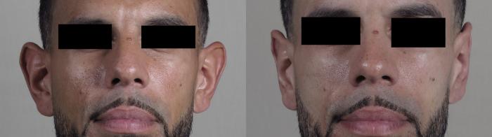 Otoplasty Case 1096 Before & After Front | Paramus, New Jersey | Parker Center for Plastic Surgery