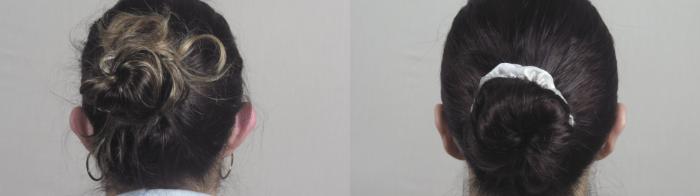 Otoplasty Case 1098 Before & After Back | Paramus, New Jersey | Parker Center for Plastic Surgery
