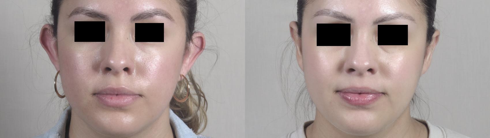 Otoplasty Case 1098 Before & After Front | Paramus, New Jersey | Parker Center for Plastic Surgery