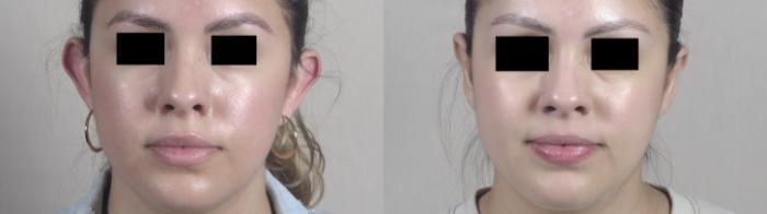 Otoplasty Case 1098 Before & After Front | Paramus, New Jersey | Parker Center for Plastic Surgery