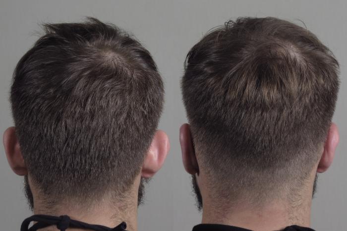 Otoplasty Case 1099 Before & After Back | Paramus, New Jersey | Parker Center for Plastic Surgery