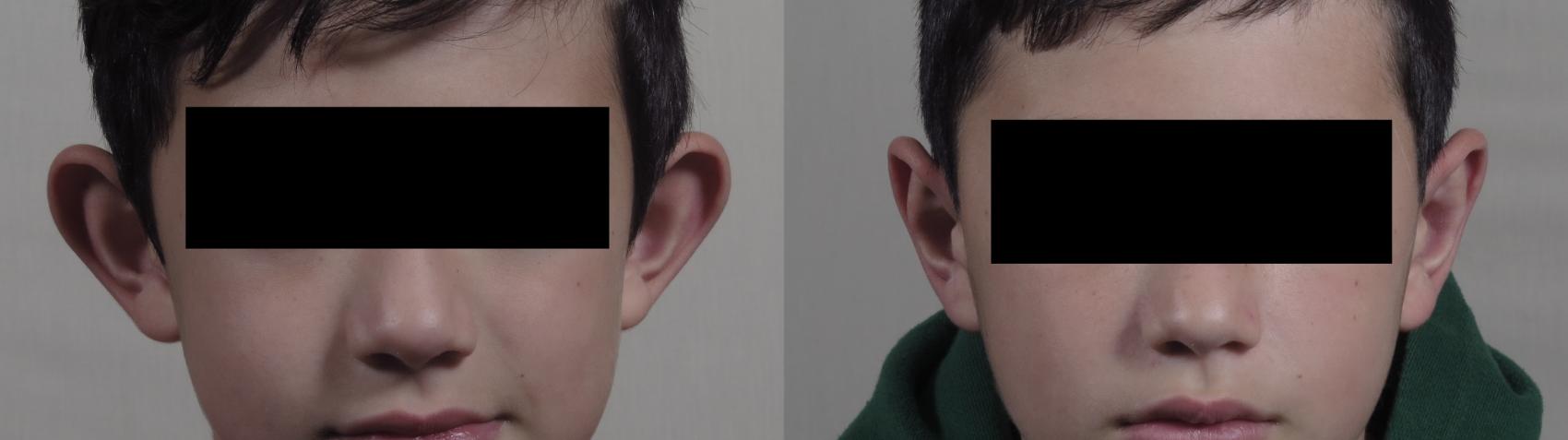 Otoplasty Case 1205 Before & After View #1  | Paramus, New Jersey | Parker Center for Plastic Surgery