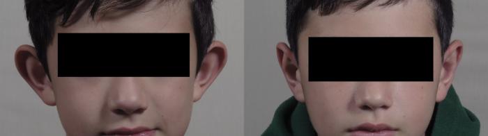 Otoplasty Case 1205 Before & After View #1  | Paramus, New Jersey | Parker Center for Plastic Surgery