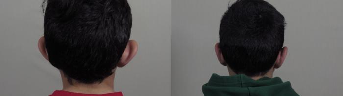 Otoplasty Case 1205 Before & After View #2  | Paramus, New Jersey | Parker Center for Plastic Surgery