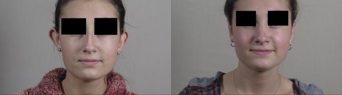 Otoplasty Case 1229 Before & After View #1  | Paramus, New Jersey | Parker Center for Plastic Surgery