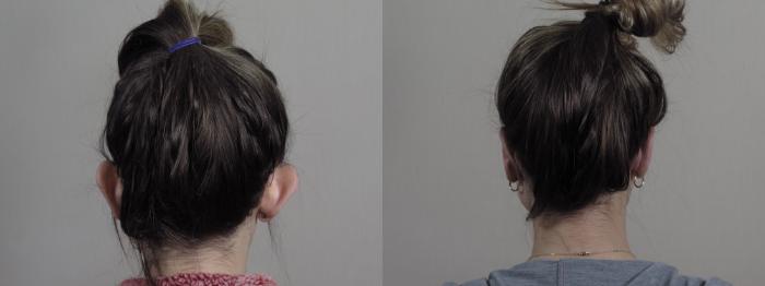 Otoplasty Case 1229 Before & After View #2 | Paramus, New Jersey | Parker Center for Plastic Surgery