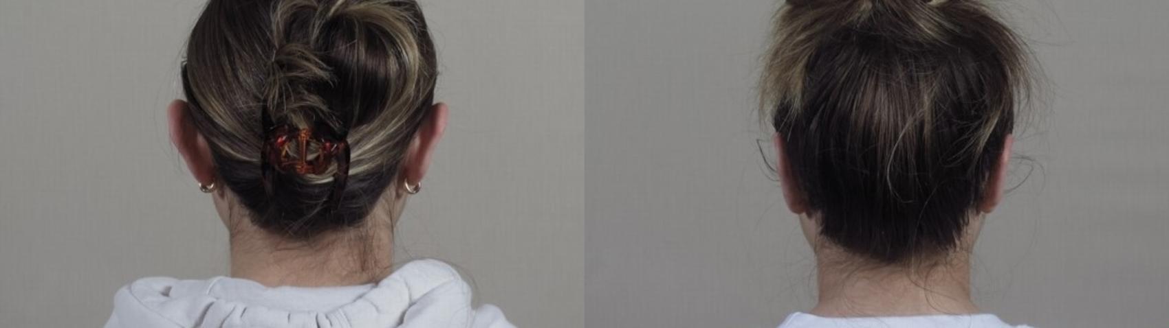 Otoplasty Case 1247 Before & After Back | Paramus, New Jersey | Parker Center for Plastic Surgery