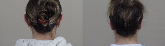 Otoplasty Case 1247 Before & After Back | Paramus, New Jersey | Parker Center for Plastic Surgery