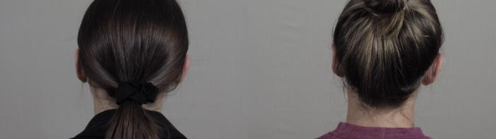 Otoplasty Case 1292 Before & After Back | Paramus, New Jersey | Parker Center for Plastic Surgery