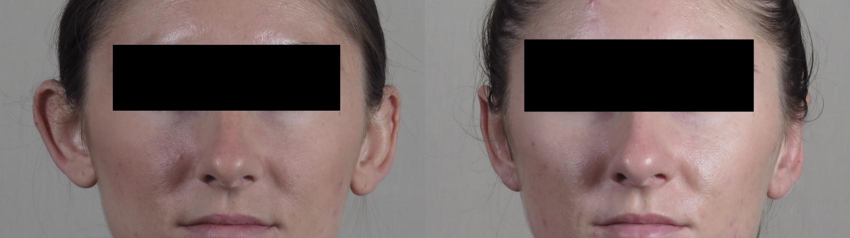 Otoplasty Case 1292 Before & After Front | Paramus, New Jersey | Parker Center for Plastic Surgery