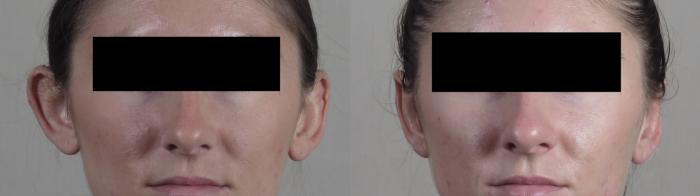 Otoplasty Case 1292 Before & After Front | Paramus, New Jersey | Parker Center for Plastic Surgery