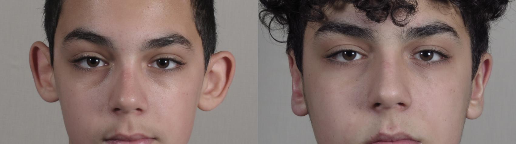 Otoplasty Case 1410 Before & After Front | Paramus, New Jersey | Parker Center for Plastic Surgery