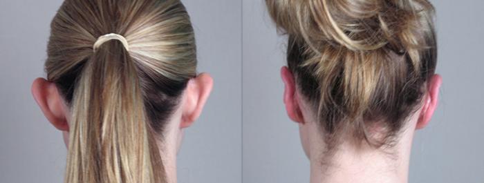 Otoplasty Case 233 Before & After View #1 | Paramus, New Jersey | Parker Center for Plastic Surgery