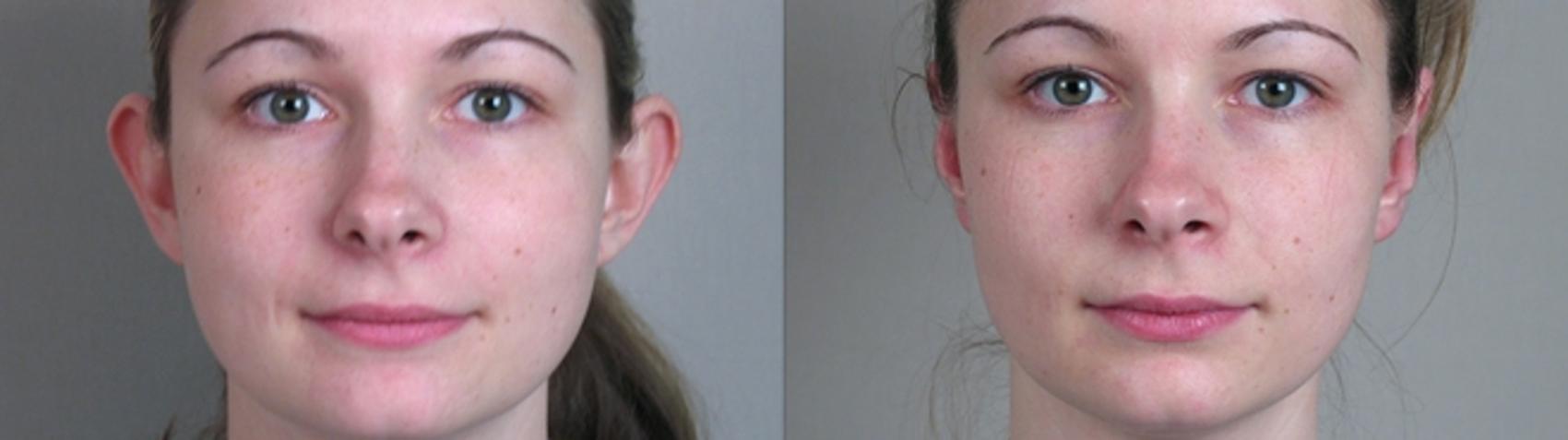 Otoplasty Case 233 Before & After View #2 | Paramus, New Jersey | Parker Center for Plastic Surgery