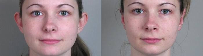 Otoplasty Case 233 Before & After View #2 | Paramus, New Jersey | Parker Center for Plastic Surgery