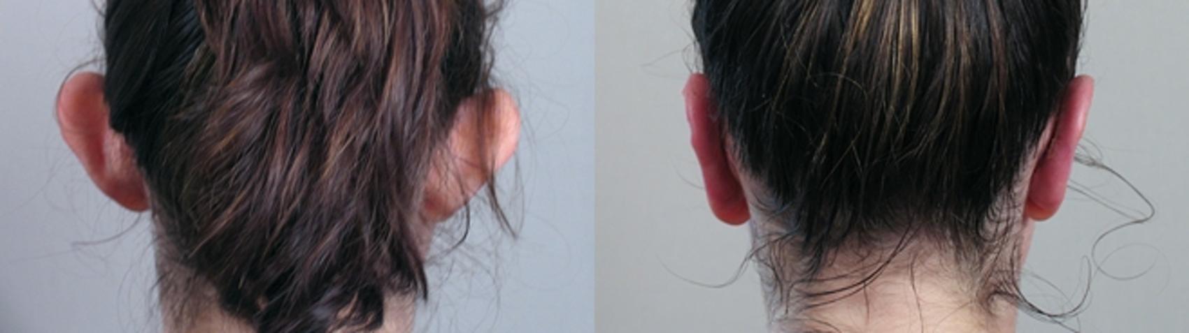Otoplasty Case 234 Before & After View #1 | Paramus, New Jersey | Parker Center for Plastic Surgery