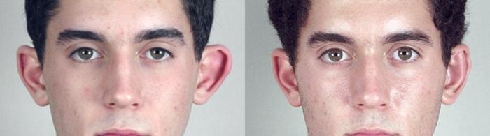 Otoplasty Case 235 Before & After View #2 | Paramus, New Jersey | Parker Center for Plastic Surgery