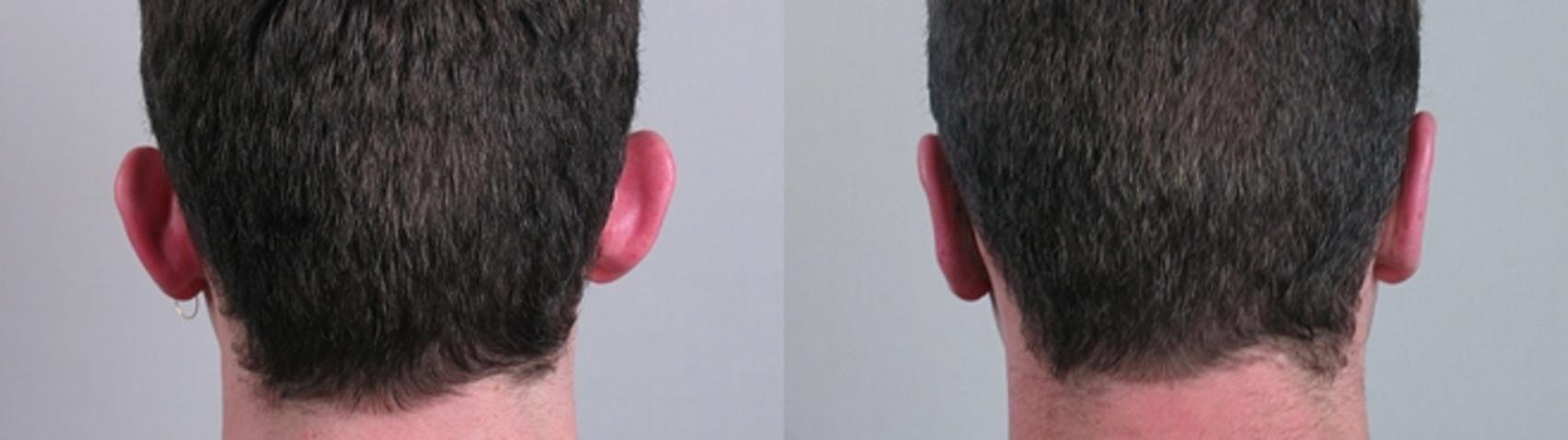 Otoplasty Case 236 Before & After View #1 | Paramus, New Jersey | Parker Center for Plastic Surgery