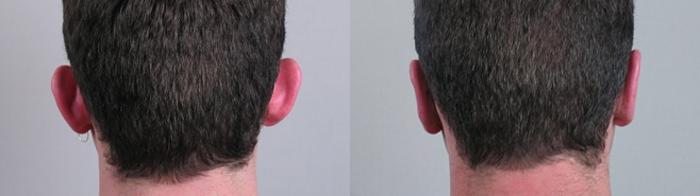 Otoplasty Case 236 Before & After View #1 | Paramus, New Jersey | Parker Center for Plastic Surgery