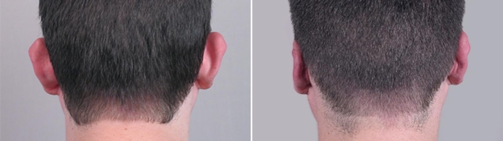 Otoplasty Case 237 Before & After View #1 | Paramus, New Jersey | Parker Center for Plastic Surgery
