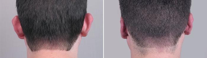 Otoplasty Case 237 Before & After View #1 | Paramus, New Jersey | Parker Center for Plastic Surgery