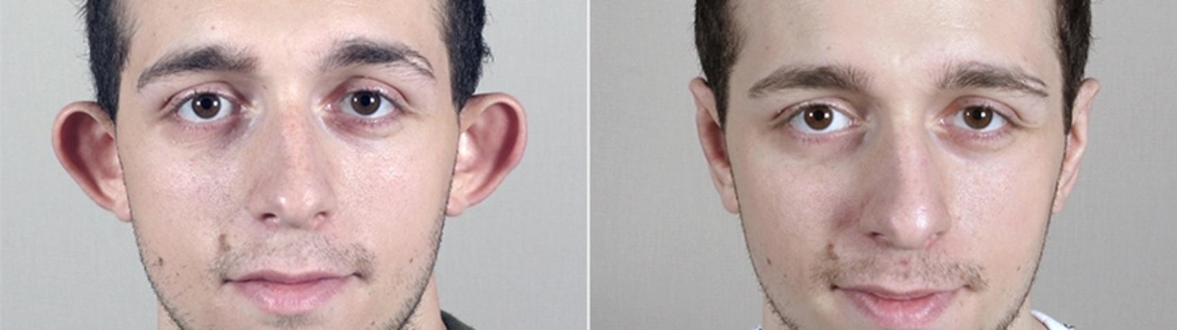 Otoplasty Case 239 Before & After View #2 | Paramus, New Jersey | Parker Center for Plastic Surgery