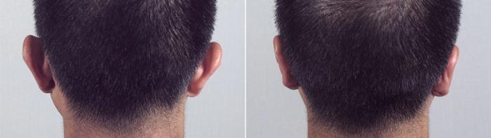 Otoplasty Case 241 Before & After View #1 | Paramus, New Jersey | Parker Center for Plastic Surgery
