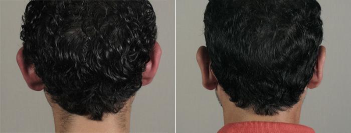 Otoplasty Case 243 Before & After View #1 | Paramus, New Jersey | Parker Center for Plastic Surgery