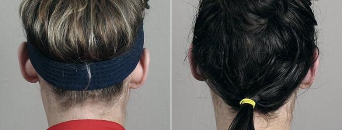 Otoplasty Case 247 Before & After View #1 | Paramus, New Jersey | Parker Center for Plastic Surgery