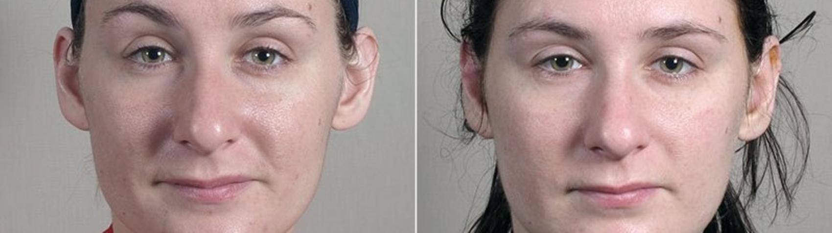 Otoplasty Case 247 Before & After View #2 | Paramus, New Jersey | Parker Center for Plastic Surgery