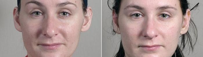 Otoplasty Case 247 Before & After View #2 | Paramus, New Jersey | Parker Center for Plastic Surgery