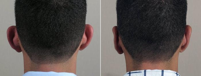 Otoplasty Case 250 Before & After View #1 | Paramus, New Jersey | Parker Center for Plastic Surgery