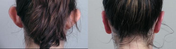 Otoplasty Case 896 Before & After View #4 | Paramus, New Jersey | Parker Center for Plastic Surgery