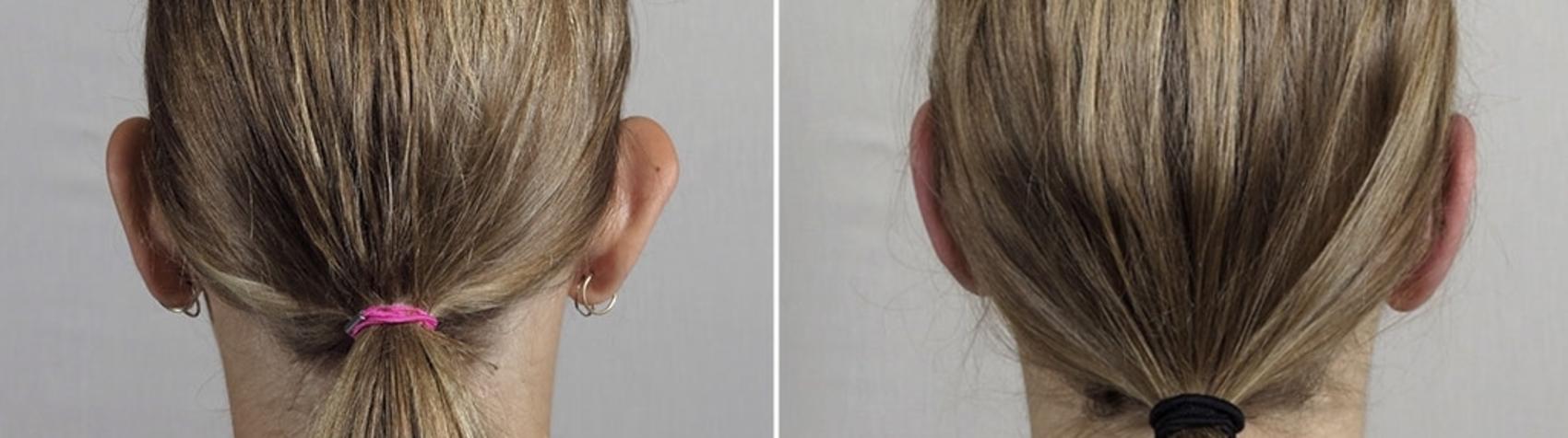 Otoplasty Case 897 Before & After View #4 | Paramus, New Jersey | Parker Center for Plastic Surgery
