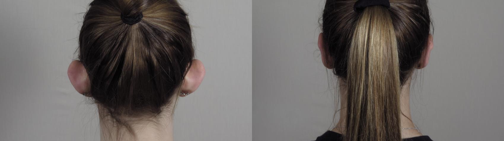 Otoplasty Case 984 Before & After Back | Paramus, New Jersey | Parker Center for Plastic Surgery