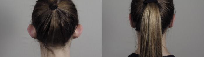 Otoplasty Case 984 Before & After Back | Paramus, New Jersey | Parker Center for Plastic Surgery