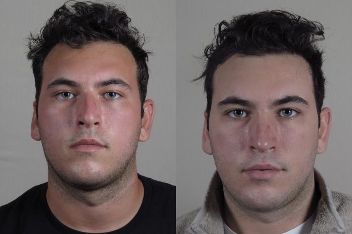Rhinoplasty Case 1029 Before & After Front | Paramus, New Jersey | Parker Center for Plastic Surgery