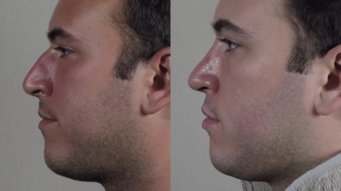 Rhinoplasty Case 1029 Before & After Right Side | Paramus, New Jersey | Parker Center for Plastic Surgery