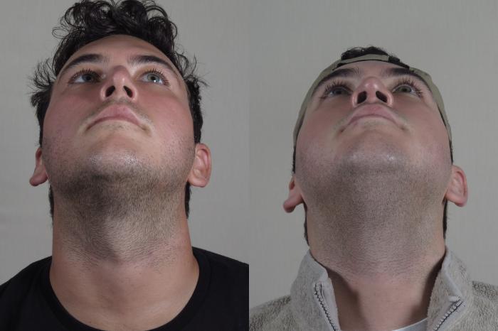 Rhinoplasty Case 1029 Before & After Worms eye | Paramus, New Jersey | Parker Center for Plastic Surgery