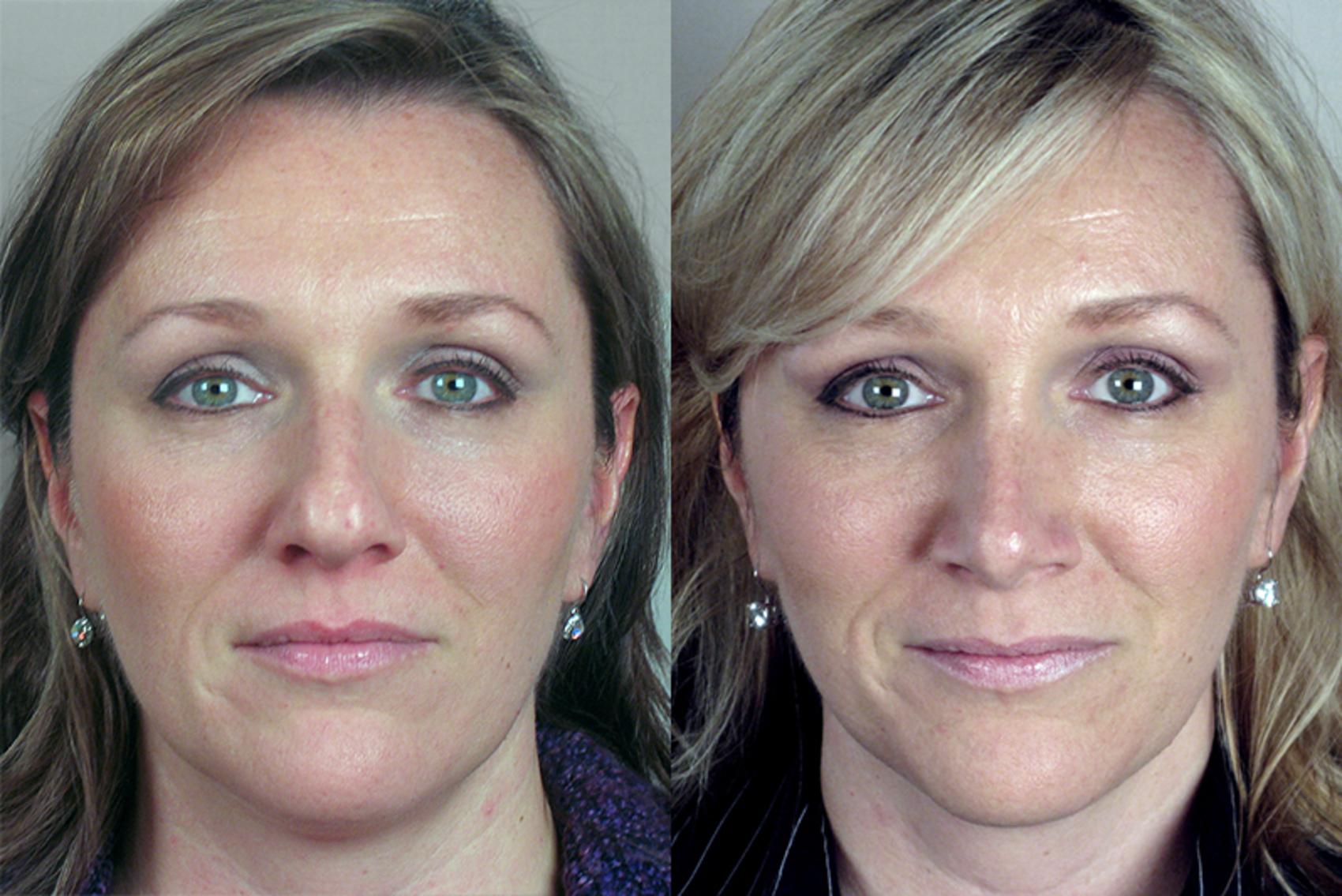 Rhinoplasty Case 117 Before & After View #1 | Paramus, New Jersey | Parker Center for Plastic Surgery