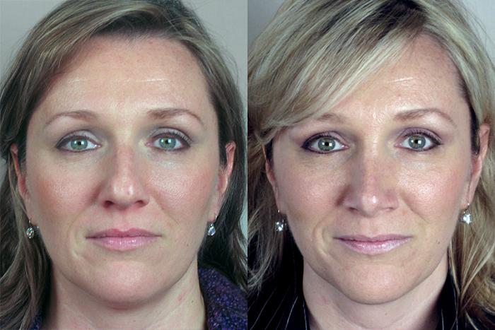 Rhinoplasty Case 117 Before & After View #1 | Paramus, New Jersey | Parker Center for Plastic Surgery