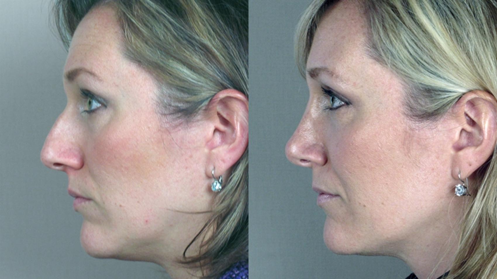 Rhinoplasty Case 117 Before & After View #2 | Paramus, New Jersey | Parker Center for Plastic Surgery